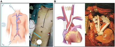Case Report: Superior Vena Cava Resection and Reconstruction for Invasive Thyroid Cancer: Report of Three Cases and Literature Review